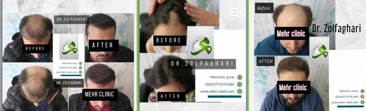 کاشت مو کرج