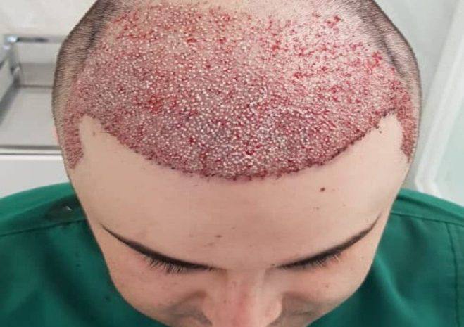 کاشت مو در کرج