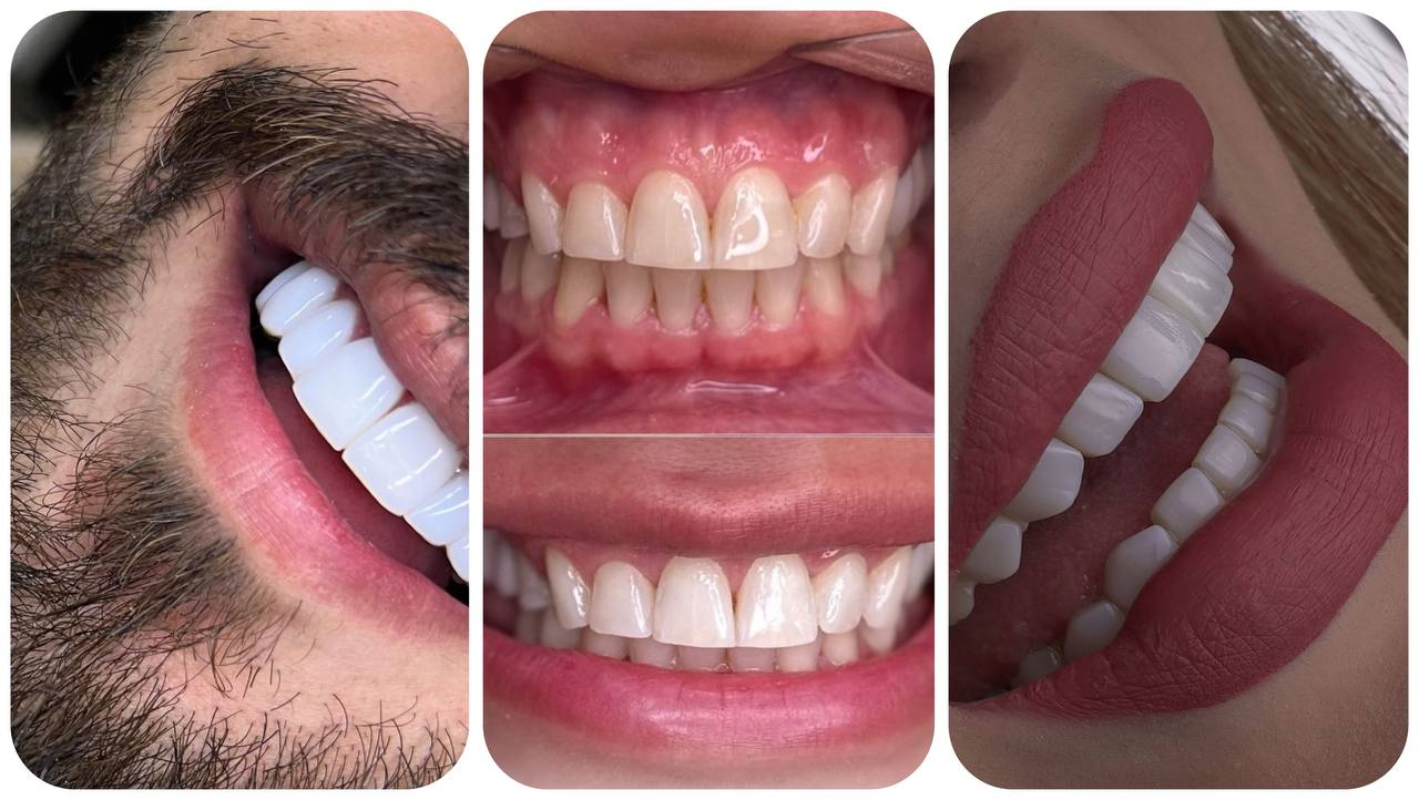 بهترین دکتر کامپوزیت در کرج