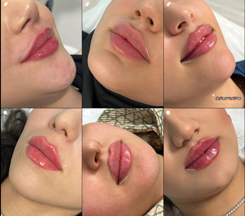 معرفی برترین دکتر تزریق ژل و فیلر در کرج