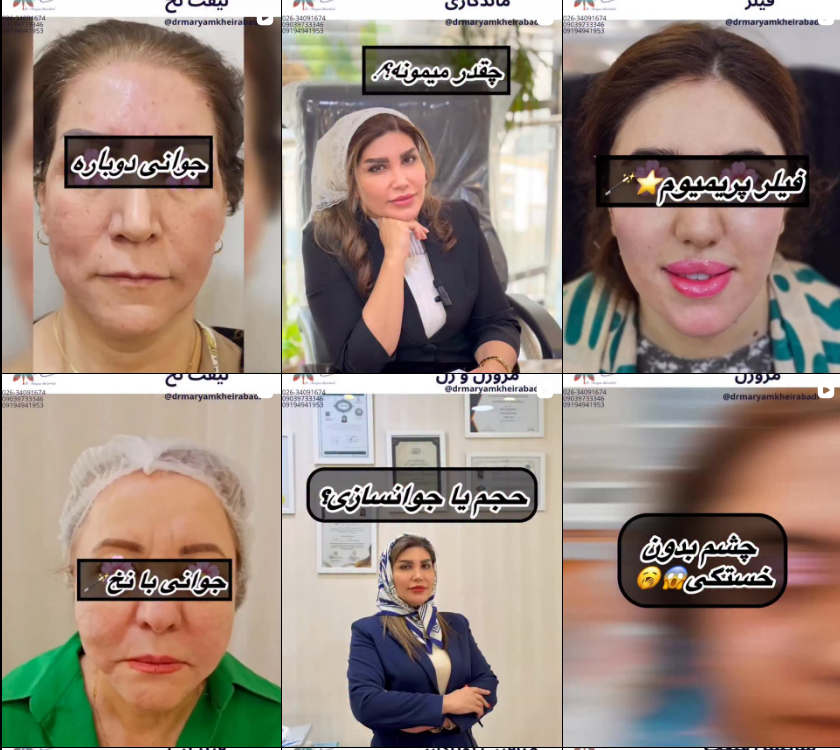 بهترین دکتر تزریق ژل و فیلر در کرج