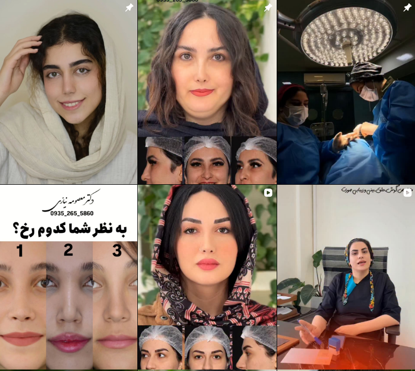 رینوپلاستی در کرج