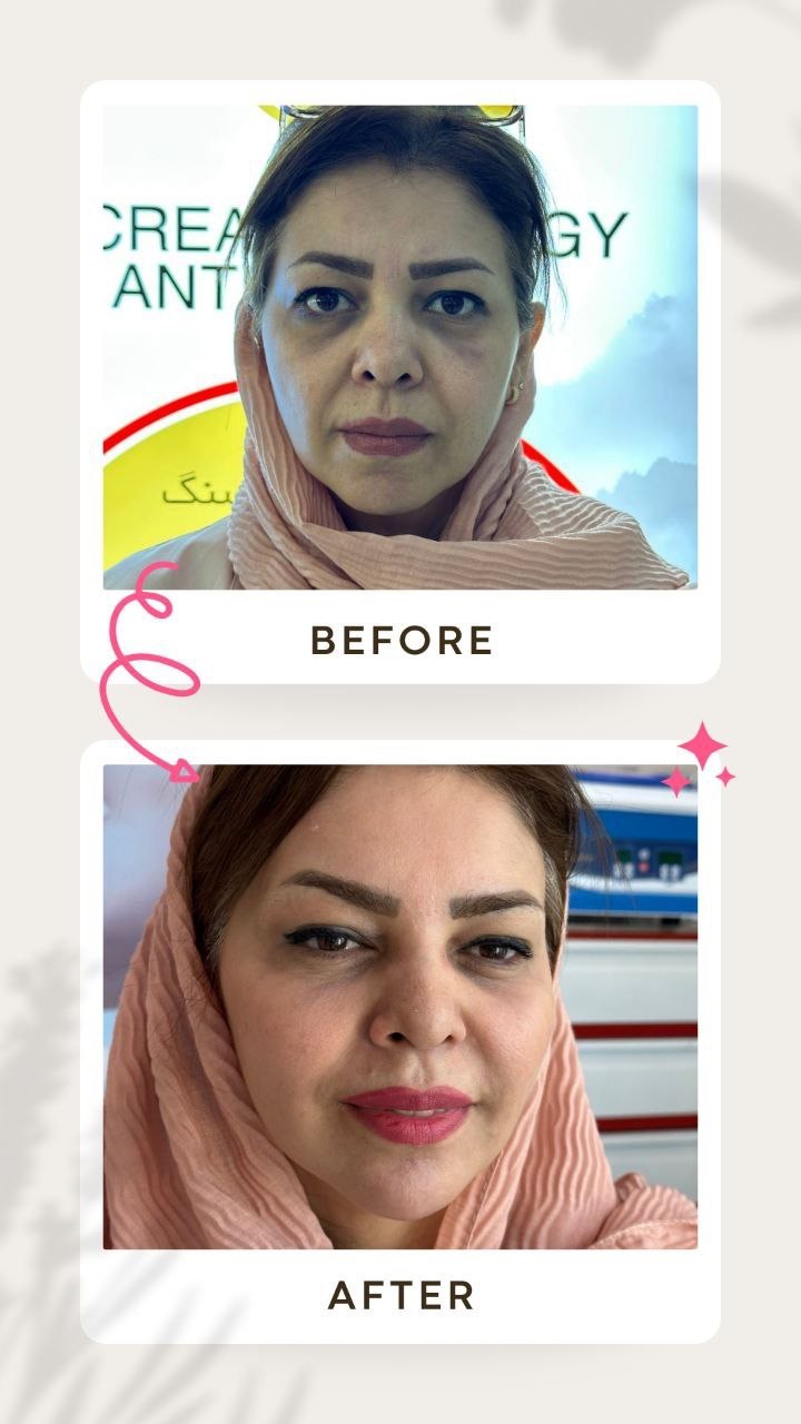 بهترین دکتر تزریق ژل و فیلر در کرج عظیمیه