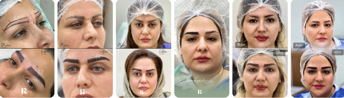 کلینیک کاشت ابرو ریحانا