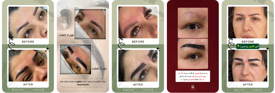 بهترین کلینیک کاشت ابرو در کرج