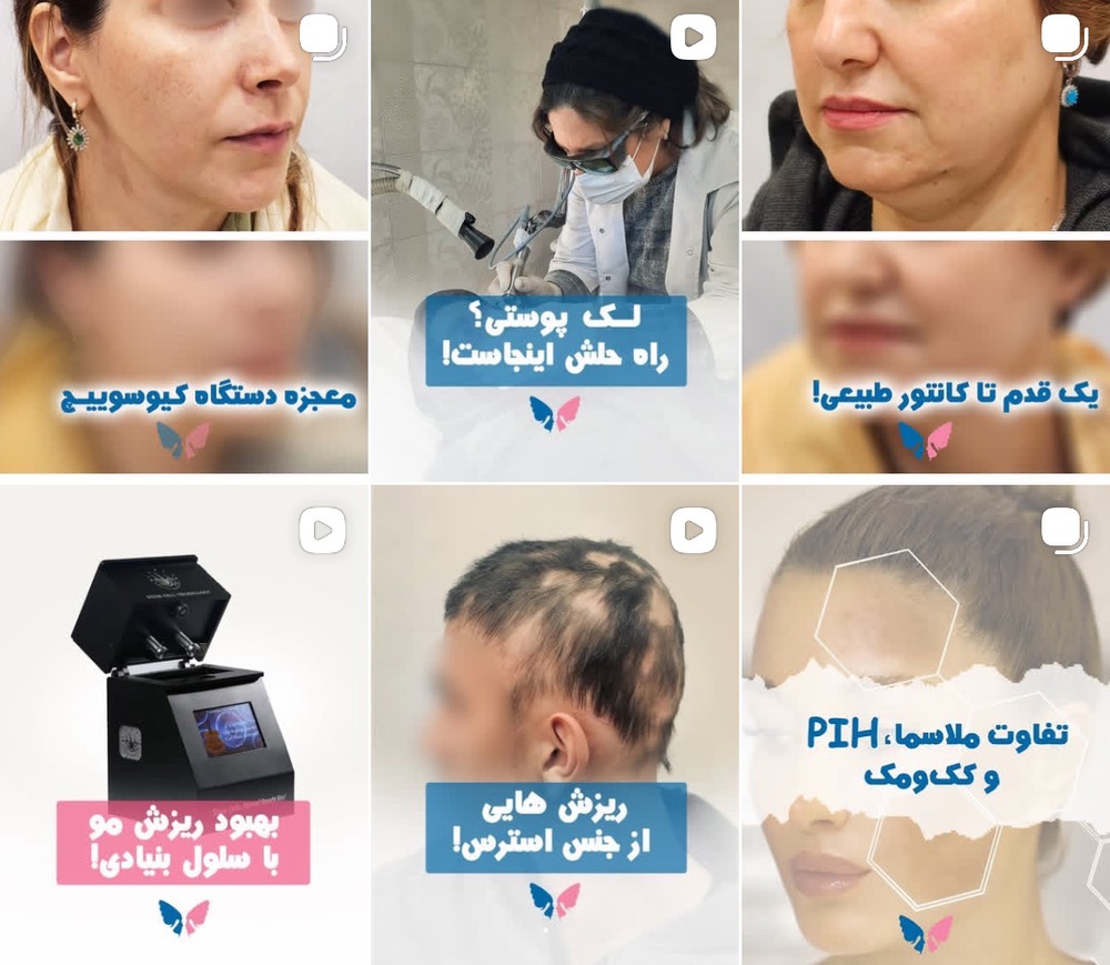 برترین مرکز پاکسازی تاتو در کرج