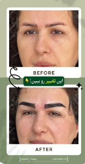 بهترین کلینیک کاشت ابرو در کرج