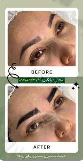 برترین کلینیک کاشت ابرو در کرج