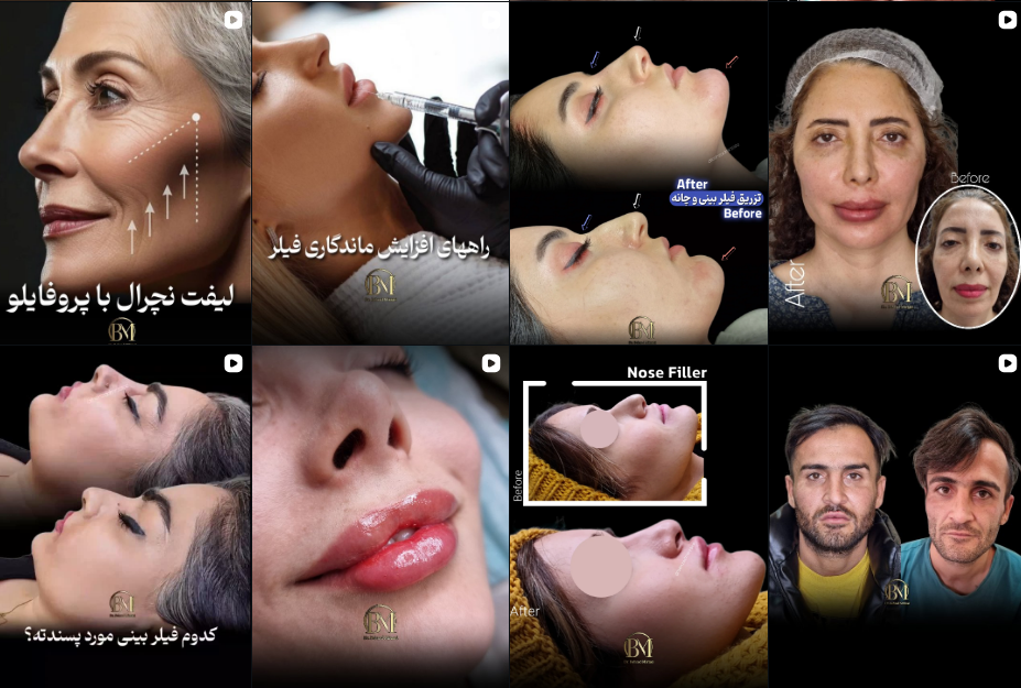تزریق فیلر لب در فردیس