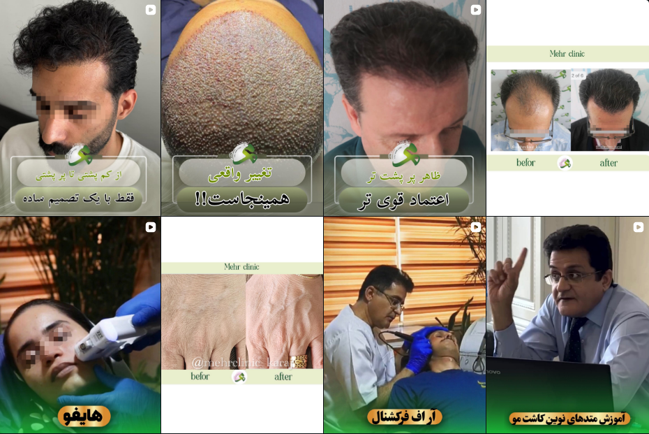برترین مرکز لیزر الکساندرایت در کرج